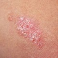 Psoriasis Home Remedies: Simple and Effective Cures for Psoriasis