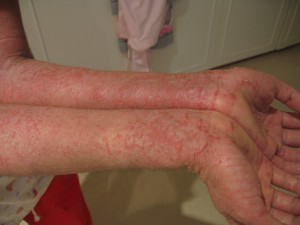 Eczema on the Arms